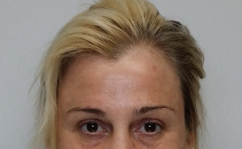 Brow Lift/Forehead Rejuvenation Case 10240 After Photo Brow Lift/Forehead Rejuvenation