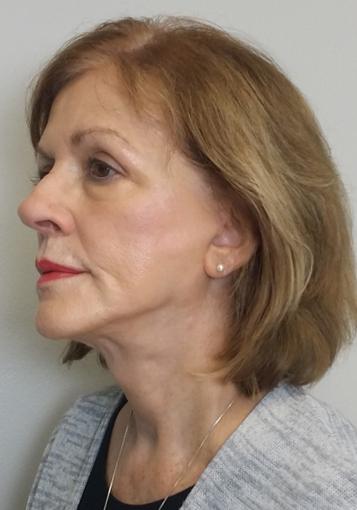 Facelift Case 10280 After Photo Facelift