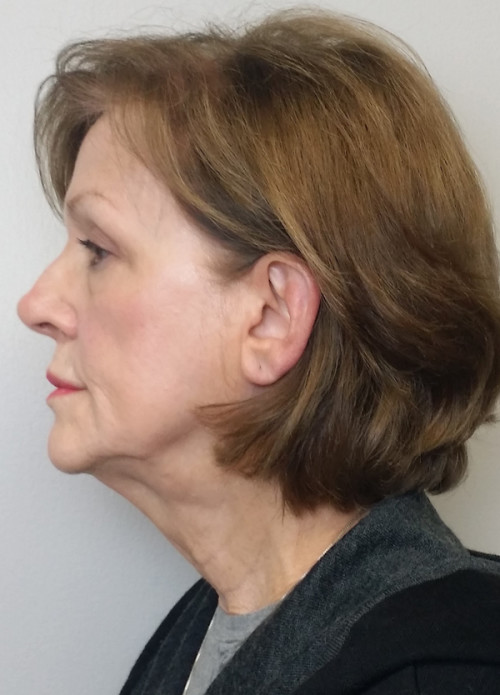 Facelift Case 10280 Before Photo Facelift