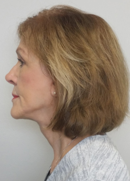 Facelift Case 10280 After Photo Facelift