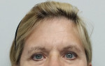 Brow Lift/Forehead Rejuvenation