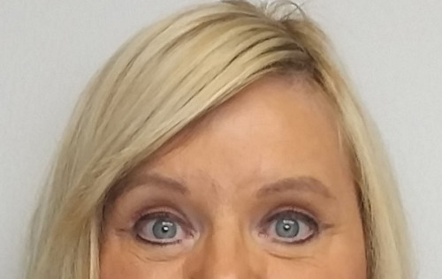 Brow Lift/Forehead Rejuvenation Case 10244 After Photo Brow Lift/Forehead Rejuvenation