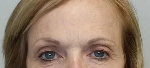 Brow Lift/Forehead Rejuvenation Case 10248 Before Photo Brow Lift/Forehead Rejuvenation