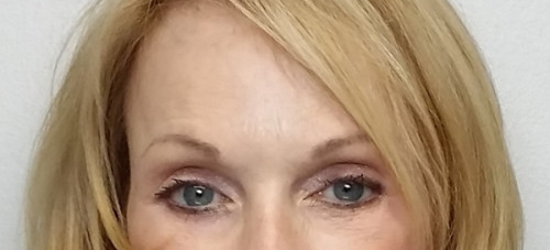 Brow Lift/Forehead Rejuvenation Case 10248 After Photo Brow Lift/Forehead Rejuvenation