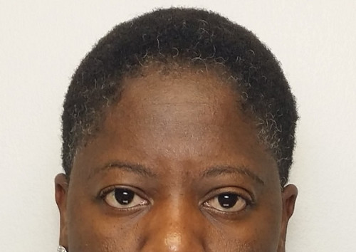 Brow Lift/Forehead Rejuvenation Case 10252 Before Photo Brow Lift/Forehead Rejuvenation