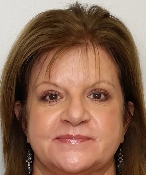 Brow Lift/Forehead Rejuvenation Case 10256 After Photo Brow Lift/Forehead Rejuvenation