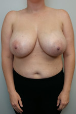 Breast Reduction