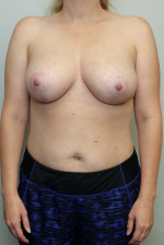 Breast Reduction