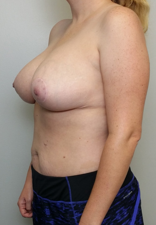 Breast Reduction Case 10150 After Photo Breast Reduction