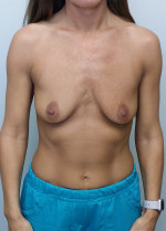 Breast Augmentation