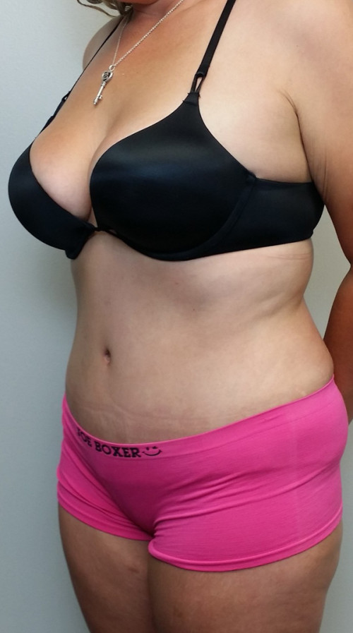 Tummy tuck (Abdominoplasty)