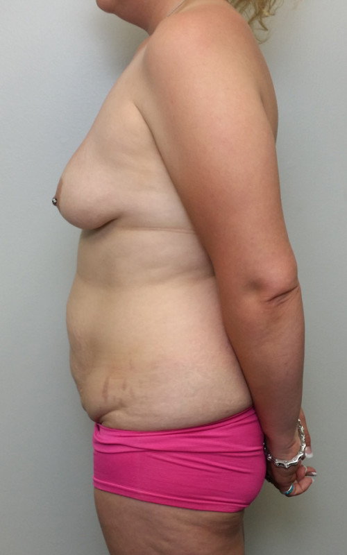 Tummy tuck (Abdominoplasty)