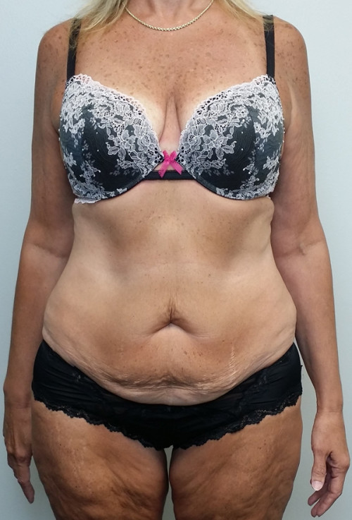 Tummy tuck (Abdominoplasty)