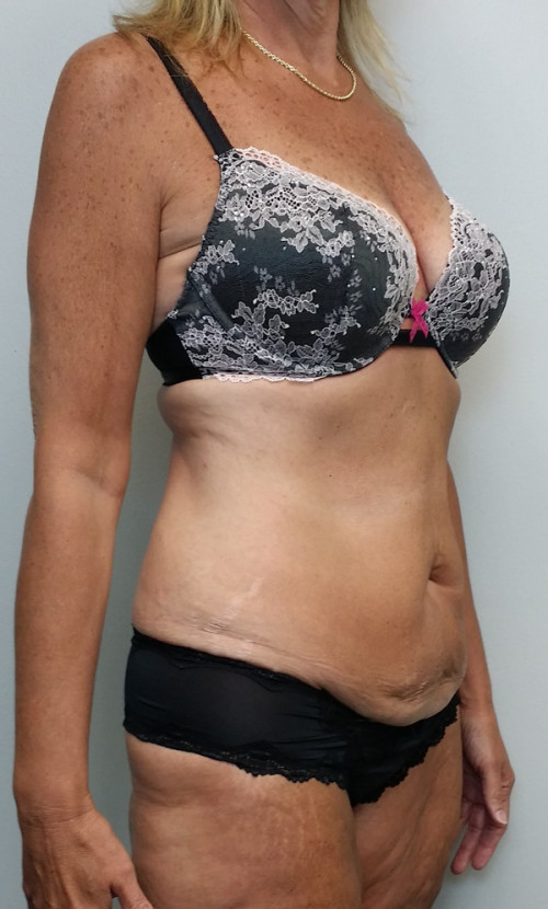 Tummy tuck (Abdominoplasty)