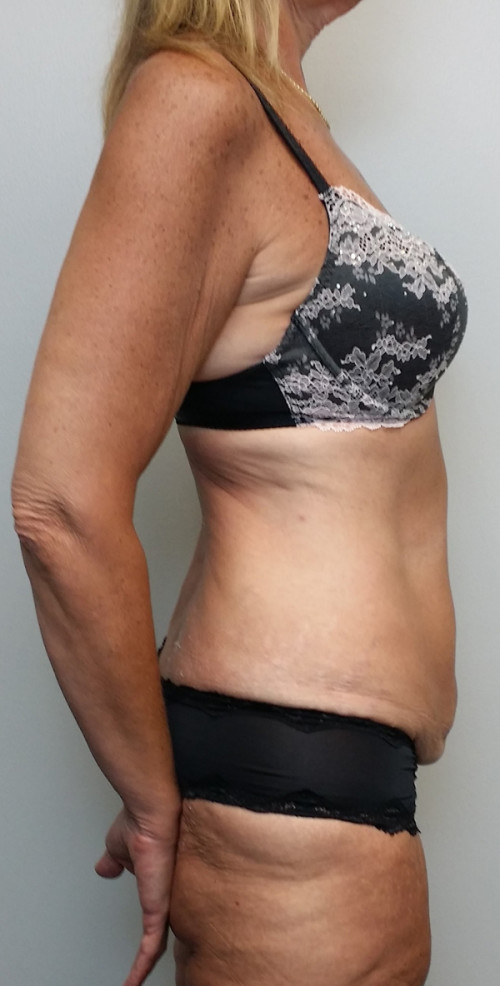 Tummy tuck (Abdominoplasty)