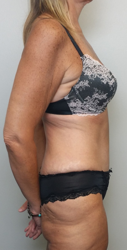 Tummy tuck (Abdominoplasty) Case 10296 After Photo Tummy tuck (Abdominoplasty)