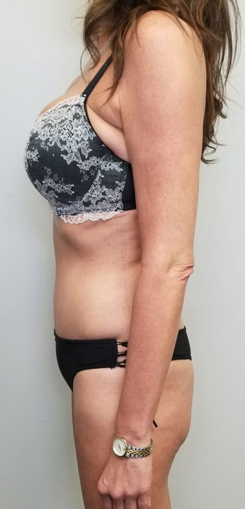 Tummy tuck (Abdominoplasty) Case 10567 After Photo Tummy tuck (Abdominoplasty)