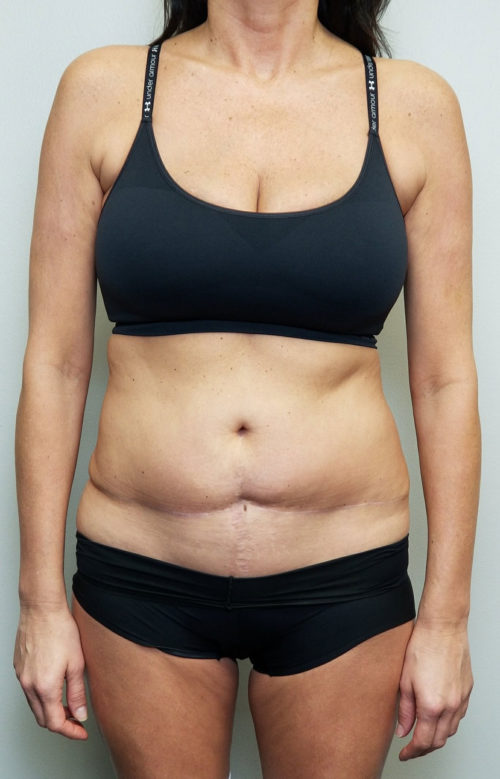 Tummy tuck (Abdominoplasty)