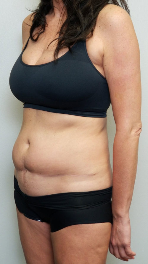 Tummy tuck (Abdominoplasty)