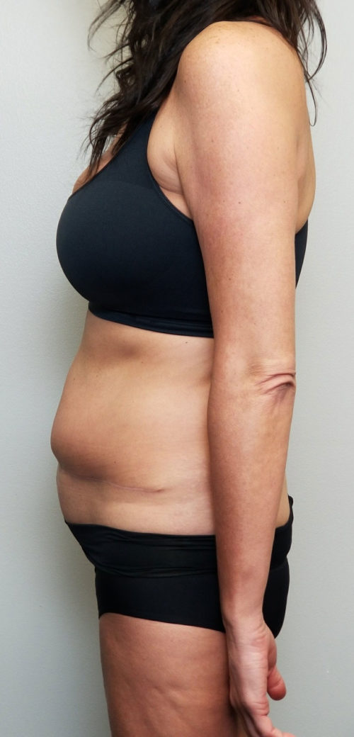 Tummy tuck (Abdominoplasty) Case 10567 Before Photo Tummy tuck (Abdominoplasty)