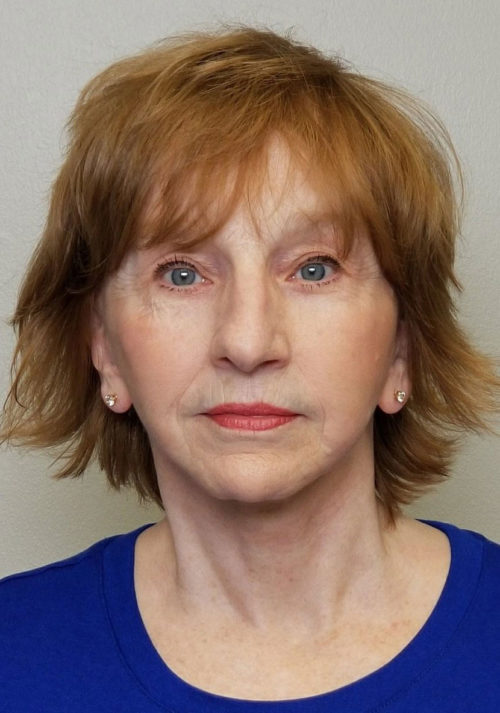 Neck Lift Case 10539 After Photo Neck Lift