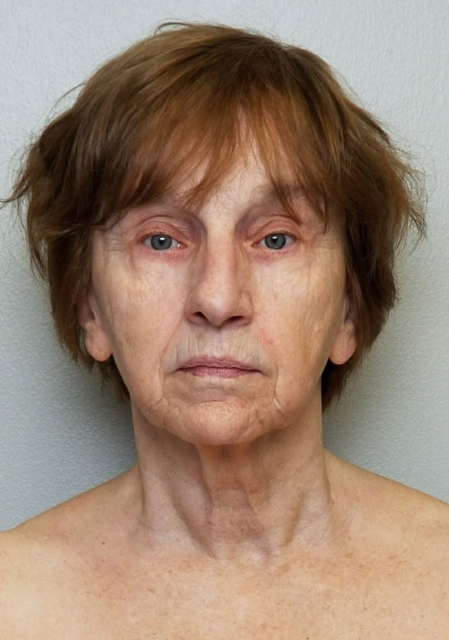 Neck Lift Case 10539 Before Photo Neck Lift