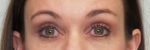 Eyelid Surgery