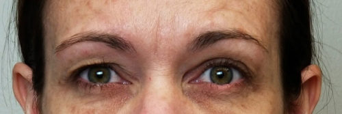 Eyelid Surgery Case 10485 Before Photo Eyelid Surgery