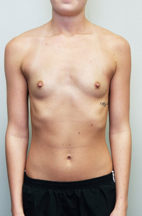 Breast Augmentation Case 10350 Before Photo Breast Augmentation