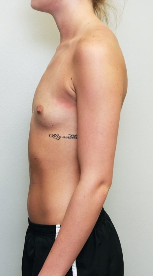 Breast Augmentation Case 10350 Before Photo Breast Augmentation
