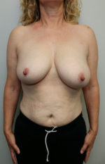 Breast Reduction