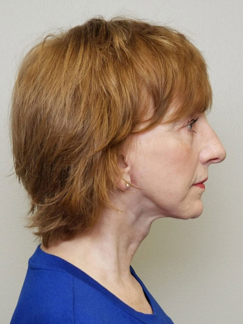 Facelift Case 10506 After Photo Facelift