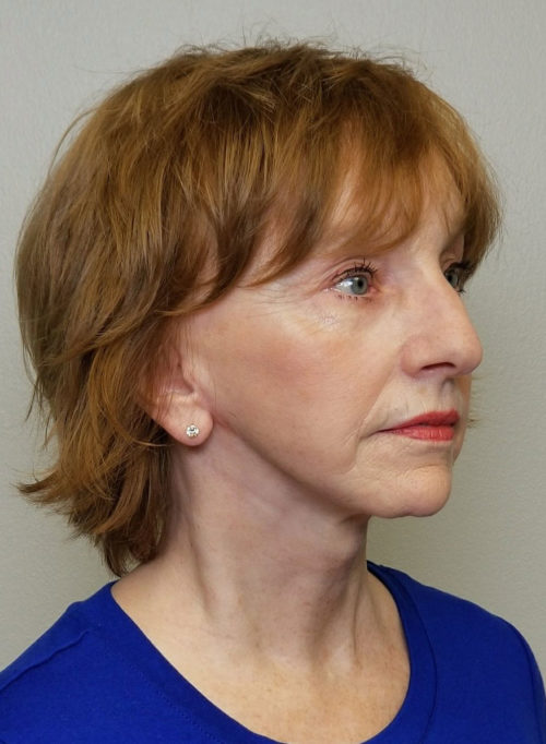 Facelift Case 10506 After Photo Facelift