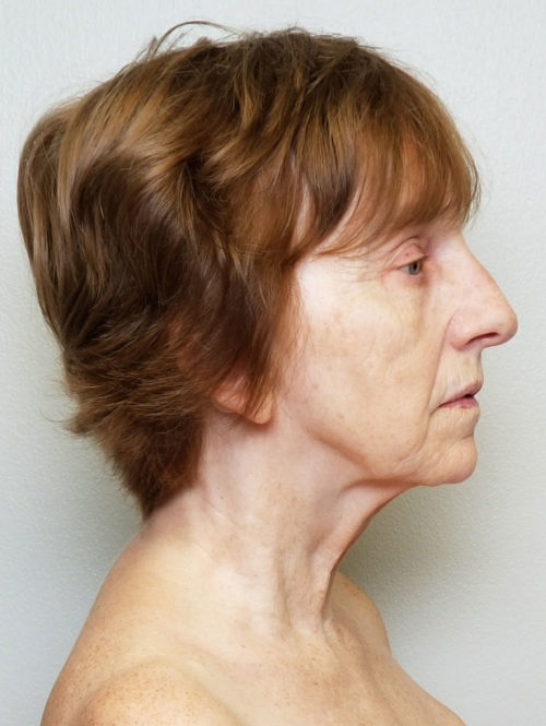 Facelift Case 10506 Before Photo Facelift