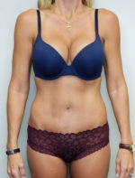 Tummy tuck (Abdominoplasty)