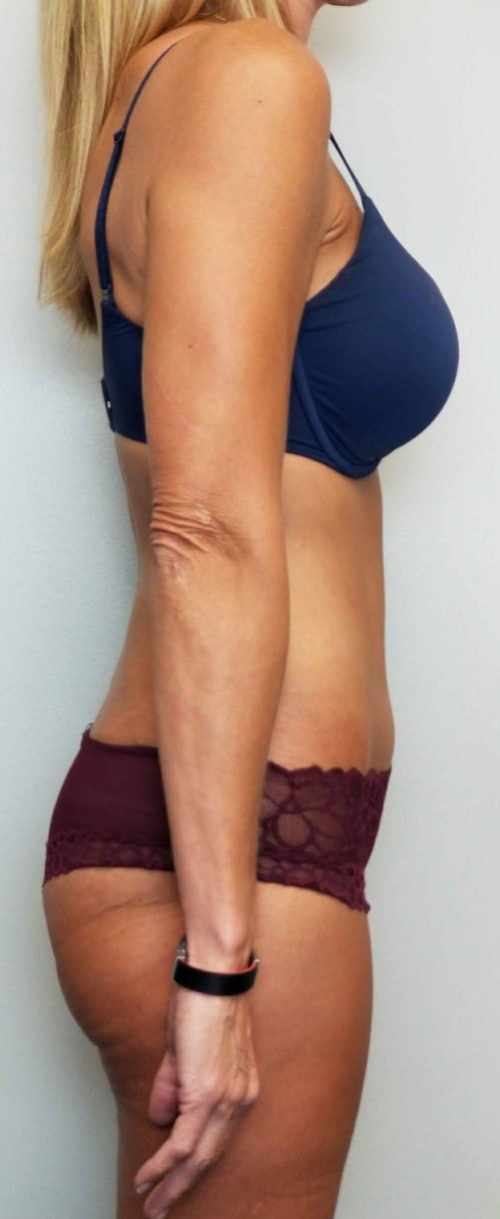 Tummy tuck (Abdominoplasty) Case 10574 After Photo Tummy tuck (Abdominoplasty)