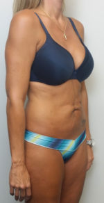 Tummy tuck (Abdominoplasty)