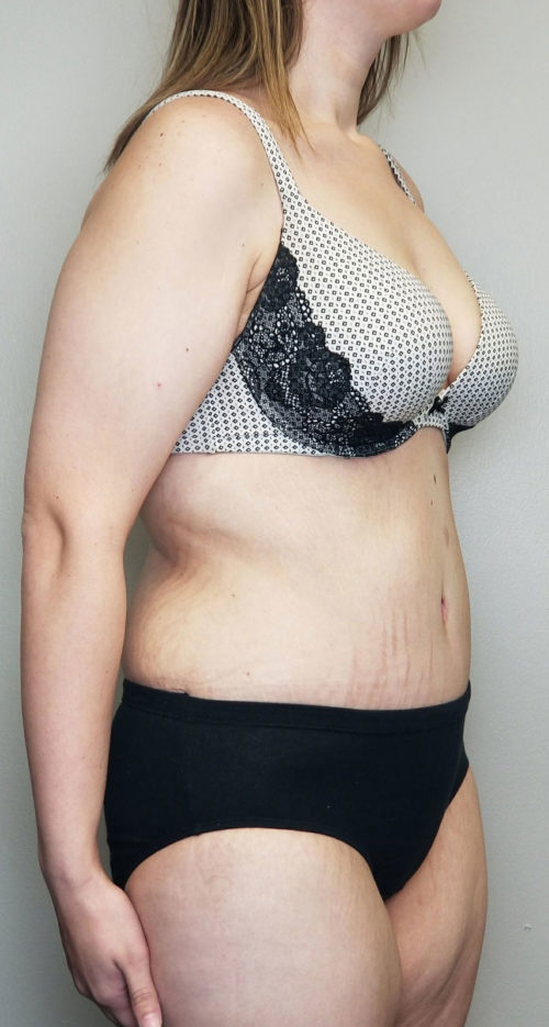 Tummy tuck (Abdominoplasty)