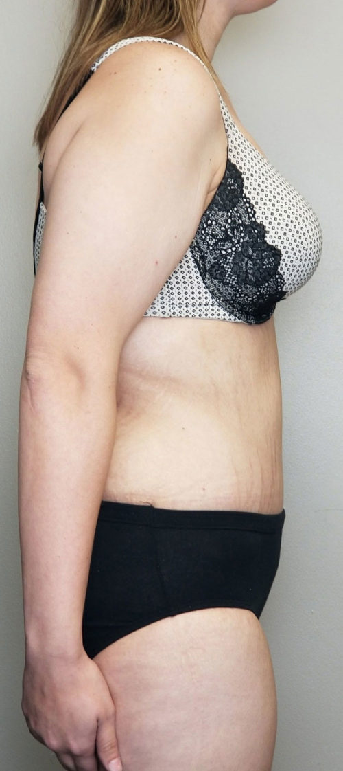 Tummy tuck (Abdominoplasty)