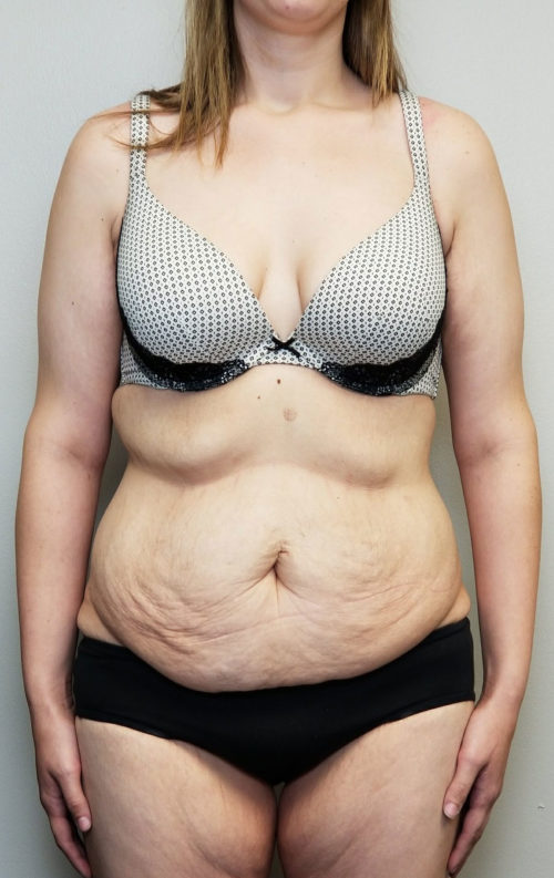 Tummy tuck (Abdominoplasty) Case 10581 Before Photo Tummy tuck (Abdominoplasty)