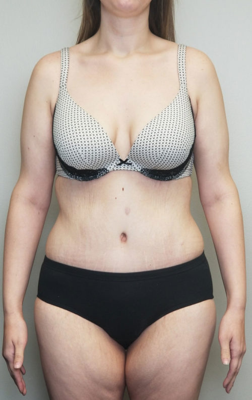 Tummy tuck (Abdominoplasty)