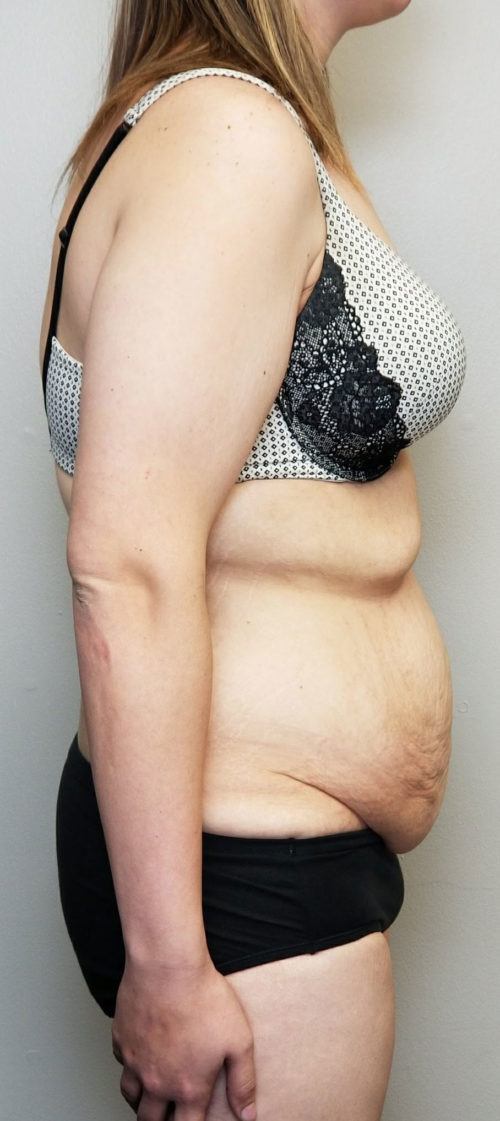 Tummy tuck (Abdominoplasty) Case 10581 Before Photo Tummy tuck (Abdominoplasty)