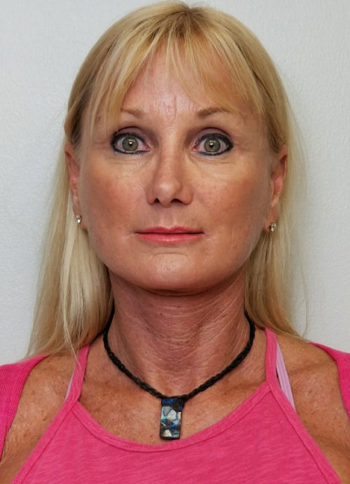 Facelift Case 10513 After Photo Facelift