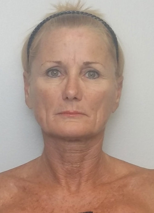 Facelift Case 10513 Before Photo Facelift