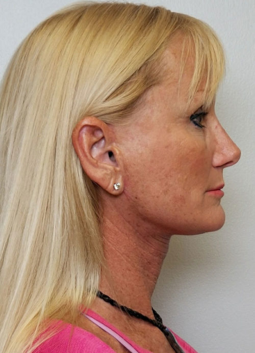 Facelift Case 10513 After Photo Facelift