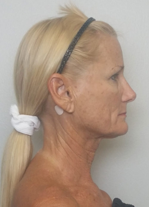 Facelift Case 10513 Before Photo Facelift