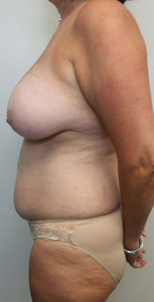 Mommy Makeover Case 10532 Before Photo Mommy Makeover