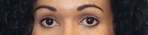 Eyelid Surgery Case 10491 After Photo Eyelid Surgery