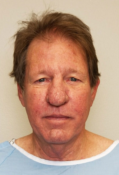 Brow Lift/Forehead Rejuvenation Case 10457 Before Photo Brow Lift/Forehead Rejuvenation