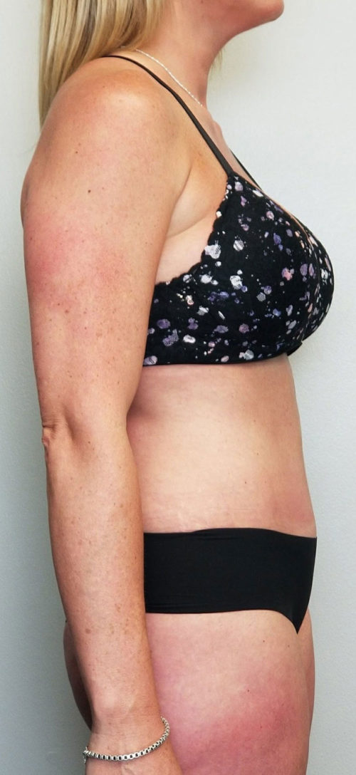 Tummy tuck (Abdominoplasty) Case 10588 After Photo Tummy tuck (Abdominoplasty)